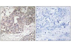 Immunohistochemistry analysis of paraffin-embedded human liver carcinoma tissue using ATG4C antibody. (ATG4C anticorps  (N-Term))