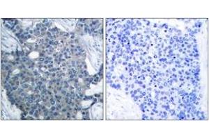 Immunohistochemistry analysis of paraffin-embedded human breast carcinoma tissue, using Stathmin 1 (Ab-24) Antibody. (Stathmin 1 anticorps  (AA 9-58))