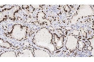 Human thyroid: immunohistochemical staining for Thyroid Transcription Factor-1.