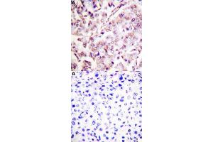 Immunohistochemical staining (Formalin-fixed paraffin-embedded sections) of human breast cancer tissue with ETS1 (phospho T38) polyclonal antibody  without blocking peptide (A) or preincubated with blocking peptide (B) under 1:50-1:100 dilution. (ETS1 anticorps  (pThr38))