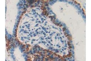 Detection of CD299 in Human Pancreatic cancer Tissue using Polyclonal Antibody to Cluster Of differentiation 299 (CD299)