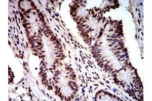 Immunohistochemical analysis of paraffin-embedded colon cancer tissues using DDX1 mouse mAb with DAB staining.