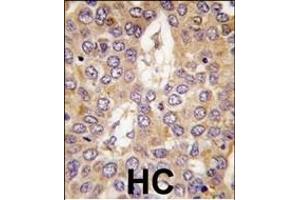 Formalin-fixed and paraffin-embedded human hepatocarcinoma tissue reacted with CK1g2 antibody (C-term), which was peroxidase-conjugated to the secondary antibody, followed by DAB staining. (Casein Kinase 1 gamma 2 anticorps  (C-Term))