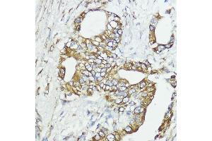 Immunohistochemistry of paraffin-embedded human lung cancer using SOCS6 antibody (ABIN6128785, ABIN6148273, ABIN6148274 and ABIN6225294) at dilution of 1:100 (40x lens). (SOCS6 anticorps  (AA 1-210))