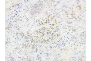 ABIN6260348 and ABIN6269272 at 1/100 staining human tongue carcinoma by IHC-P. (CEBPA anticorps  (N-Term))