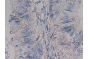 Detection of SDC1 in Human Colorectal cancer Tissue using Polyclonal Antibody to Syndecan 1 (SDC1)