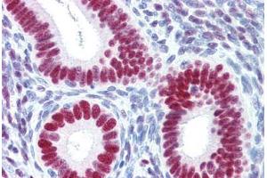 Human Uterus (formalin-fixed, paraffin-embedded) stained with PGR antibody ABIN364377 at 20 ug/ml followed by biotinylated goat anti-rabbit IgG secondary antibody ABIN481713, alkaline phosphatase-streptavidin and chromogen.