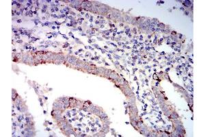 Immunohistochemical analysis of paraffin-embedded endometrial cancer tissues using BAX mouse mAb with DAB staining. (BAX anticorps  (AA 13-160))
