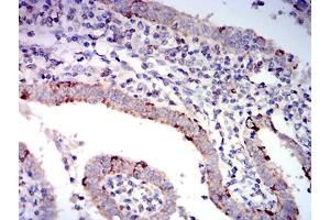 Immunohistochemical analysis of paraffin-embedded endometrial cancer tissues using BAX mouse mAb with DAB staining.
