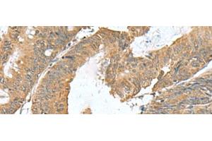 Immunohistochemistry of paraffin-embedded Human colorectal cancer tissue using RAB23 Polyclonal Antibody at dilution of 1:50(x200) (RAB23 anticorps)