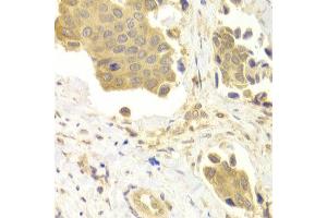 Immunohistochemistry of paraffin-embedded Human mammary cancer using GABARAP antibody at dilution of 1:100 (x400 lens). (GABARAP anticorps)