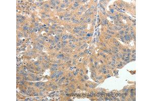 Immunohistochemistry of Human thyroid cancer using TERT Polyclonal Antibody at dilution of 1:50 (TERT anticorps)