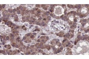 ABIN6273908 at 1/100 staining Human liver cancer tissue by IHC-P. (SSTR3 anticorps  (C-Term))