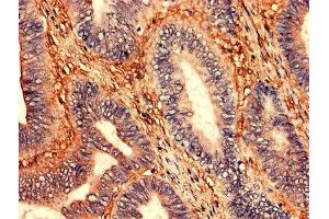 Immunohistochemistry analysis of human colon cancer using ABIN7176531 at dilution of 1:100 (ZNF791 anticorps  (AA 1-250))
