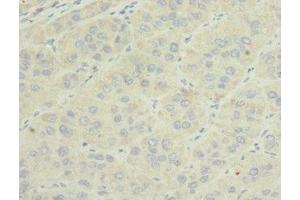 Immunohistochemistry of paraffin-embedded human liver cancer using ABIN7159816 at dilution of 1:100 (OGN anticorps  (AA 20-298))