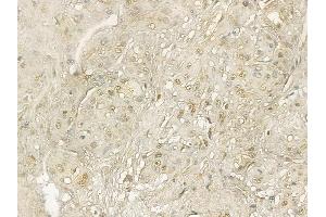 PCGF1 Mouse Monoclonal Antibody at 1/100 staining human esophageal cancer and adjacent non-tumor tissue by IHC-P. (PCGF1 anticorps)