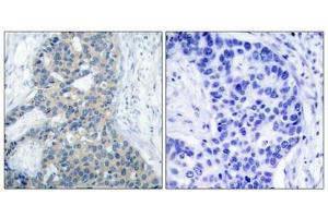 Immunohistochemical analysis of paraffin-embedded human breast carcinoma tissue using Stathmin 1(Phospho-Ser38) Antibody(left) or the same antibody preincubated with blocking peptide(right).