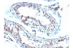 Formalin-fixed, paraffin-embedded human Testicular Carcinoma stained with Moesin Mouse Monoclonal Antibody (MSN/493).