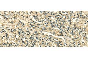 Immunohistochemistry of paraffin-embedded Human prostate cancer tissue using SDF4 Polyclonal Antibody at dilution 1:35 (SDF4 anticorps)