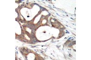 Immunohistochemical analysis of Estrogen Receptor alpha staining in human breast cancer formalin fixed paraffin embedded tissue section. (Estrogen Receptor alpha anticorps)