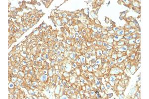 Formalin-fixed, paraffin-embedded human Renal Cell Carcinoma stained with EpCAM Rabbit Polyclonal Antibody.