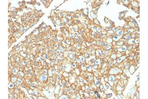 Formalin-fixed, paraffin-embedded human Renal Cell Carcinoma stained with EpCAM Rabbit Polyclonal Antibody. (EpCAM anticorps)