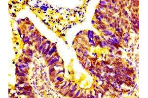 IHC image of ABIN7151890 diluted at 1:500 and staining in paraffin-embedded human ovarian cancer performed on a Leica BondTM system.