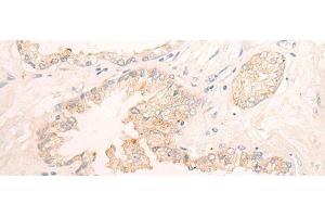 Immunohistochemistry of paraffin-embedded Human prost ate cancer tissue using ELANE Polyclonal Antibody at dilution of 1:25(x200) (ELANE anticorps)