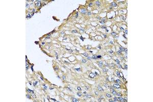 Immunohistochemistry of paraffin-embedded human prostate cancer using ASIP antibody (ABIN5974140) at dilution of 1/100 (40x lens). (ASIP anticorps)