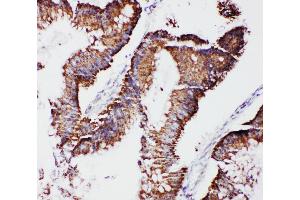 Anti-mtTFA antibody, IHC(P) IHC(P): Human Intestinal Cancer Tissue