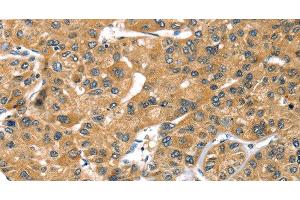 Immunohistochemistry of paraffin-embedded Human liver cancer using PRSS50 Polyclonal Antibody at dilution of 1:30 (PRSS50 anticorps)