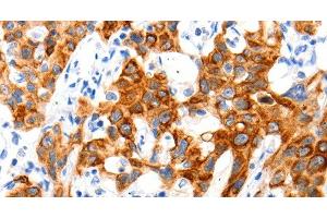 Immunohistochemistry of paraffin-embedded Human lung cancer tissue using SLC2A11 Polyclonal Antibody at dilution 1:140 (SLC2A11 anticorps)