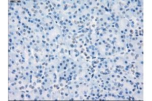 Immunohistochemical staining of paraffin-embedded Adenocarcinoma of colon tissue using anti-LTA4Hmouse monoclonal antibody. (LTA4H anticorps)