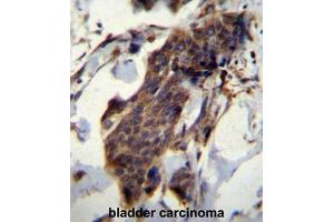CCDC13 Antibody (N-term) immunohistochemistry analysis in formalin fixed and paraffin embedded human bladder carcinoma followed by peroxidase conjugation of the secondary antibody and DAB staining. (CCDC13 anticorps  (N-Term))