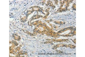 Immunohistochemistry of Human colon cancer using ASB8 Polyclonal Antibody at dilution of 1:50 (ASB8 anticorps)