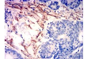 Immunohistochemical analysis of paraffin-embedded colon cancer tissues using CALD1 mouse mAb with DAB staining.