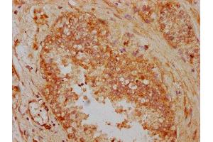 IHC image of ABIN7165406 diluted at 1:300 and staining in paraffin-embedded human prostate cancer performed on a Leica BondTM system. (FAM13A anticorps  (AA 1-201))