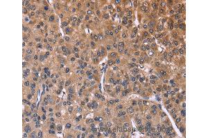 Immunohistochemistry of Human liver cancer using SEPT7 Polyclonal Antibody at dilution of 1:60 (Septin 7 anticorps)