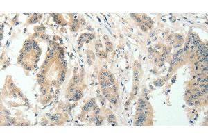 Immunohistochemistry of paraffin-embedded Human colon cancer using SIRT3 Polyclonal Antibody at dilution of 1:30 (SIRT3 anticorps)