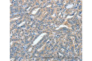 Immunohistochemistry of Human colon cancer using ANGPT1 Polyclonal Antibody at dilution of 1:50 (Angiopoietin 1 anticorps)