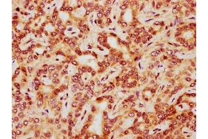 IHC image of nphHU diluted at 1:20 and staining in paraffin-embedded human liver cancer performed on a Leica BondTM system. (HIST1H3A anticorps  (AA 37-48))