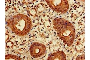 Immunohistochemistry of paraffin-embedded human colon cancer using ABIN7157550 at dilution of 1:100 (KIDINS220 anticorps  (AA 1077-1370))