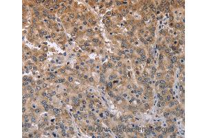 Immunohistochemistry of Human liver cancer using ECE1 Polyclonal Antibody at dilution of 1:50 (MAPRE3 anticorps)