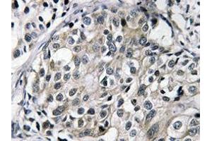 Immunohistochemistry (IHC) analyzes of TAT antibody in paraffin-embedded human breast carcinoma tissue. (HTATSF1 anticorps)