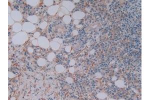 Detection of FKBP7 in Human Skin cancer Tissue using Polyclonal Antibody to FK506 Binding Protein 7 (FKBP7)