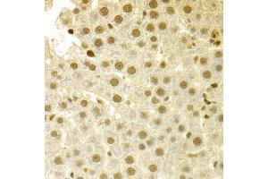 Immunohistochemistry of paraffin-embedded human liver injury using SFN Antibody. (14-3-3 sigma/SFN anticorps  (AA 1-248))