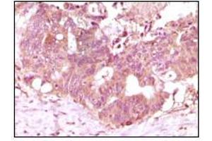 Immunohistochemical analysis of paraffin-embedded human recturn adenocarcinoma tissue showing cytoplasmic localization using FGF2 mouse mAb with DAB staining. (FGF2 anticorps)