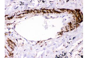Anti- SHP2 Picoband antibody,IHC(P) IHC(P): Human Lung Cancer Tissue (PTPN11 anticorps  (N-Term))