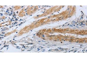 Immunohistochemistry of paraffin-embedded Human gastric cancer using NPR1 Polyclonal Antibody at dilution of 1:30 (NPR1 anticorps)