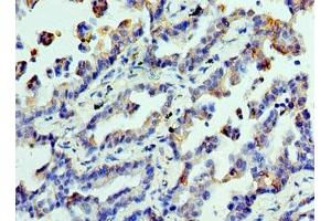 Immunohistochemistry of paraffin-embedded human lung cancer using ABIN7147858 at dilution of 1:100 (CLTA anticorps  (AA 1-218))